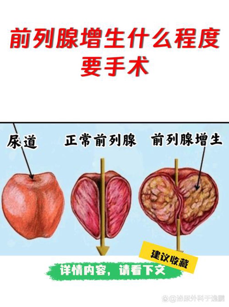 前列腺炎治疗：走出治疗误区